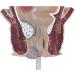 Medical Science Rectum Fissure Lesion Model 5X Human Pathology Model Hemorrhoid Anal Fistula Medical Organ Model - Buy Online on GoSupps.com