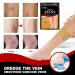 OTBK Varicose Vein Treatment Patch (36pcs) | Leg Spider Vein Removal | Improve Blood Circulation & Relieve Fatigue | One Size - Buy Online on GoSupps.com