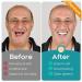 Dentures DIY Kit, Create Your Perfect Smile at Home: DIY Denture Fake Teeth Kit - Easy, Affordable, and Customizable Denture Solution-AEE1115 Pink - Buy Online on GoSupps.com