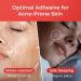 Sosky Pimple Patches - Invisible Hydrocolloid Acne Stickers with Salicylic Acid | 192 Count for Zits & Blemishes - Buy Online on GoSupps.com