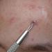 Suvorna Skinpal S90 - Professional Blackhead and Acne Remover Tool with Surgical Steel for Clear Skin - Buy Online on GoSupps.com