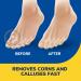 Dr. Scholl's Liquid Corn & Callus Remover - Buy Online on GoSupps.com