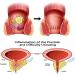 FEETT Heca Herbal Hemorrhoid Capsules - Fast Relief from Itching, Burning, and Pain (5pcs) - Buy Online on GoSupps.com