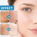Acne Serum With Plant-Based Formula Dark Spot Correcting Glow Serum Dark Spot Serum Brightening Serum Hydrating Serum Improve Redness And Blemishes Smoothing & Calming Suitable For All Skin Types - Buy Online on GoSupps.com
