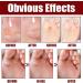 Extra Strong Foot Chicken Removal Gel - Effective Chicken Eye Remover for All Skin Types | Premium Foot Care Solution (1 Piece) - Buy Online on GoSupps.com