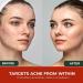 Acne Cleanse Capsules.Powerful Vitex Angus Extract, Niacinamide, Biotin for Teens & Adults. Organic Acne Treatment,Cystic Pimples, Oily Skin to Natural Clear Skin Vitamins Supplement- 60 Count - Buy Online on GoSupps.com