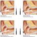 Rehomy Digital LED Otoscope Ear Camera - Earwax Removal Kit & Cleaning Tool for Perfect Ear Care - Buy Online on GoSupps.com