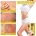 Zemibor Revitaskin Eczema Treatment Cream - Psoriasis Relief for Adults (3pcs) - Buy Online on GoSupps.com