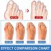 Best Bunion Corrector - Orthopedic Splint for Hallux Valgus & Hammer Toe - Men & Women Night Use - Buy Online on GoSupps.com
