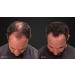 LUXE Hair Thickening Fibers - Hypoallergenic, Dermatologist Tested - 2 Months+ Supply in Dark Brown - Buy Online on GoSupps.com