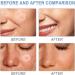 Acne Pimple Patches - Absorbing Cover with Tea Tree Oil Invisible Blemish Spot Hydrocolloid Skin Treatment Facial Stickers Five Sizes Blends in with skin - Buy Online on GoSupps.com