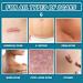 Scar Gel 20 G Effective in Treating Scars C-Section Scars Stretch Marks Acne Surgery Burns Effective On Old and New Scars - Buy Online on GoSupps.com
