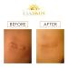 Keloid Removal Duo - Effective Treatment for Keloids | Fast International Shipping - Buy Online on GoSupps.com