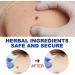 Maximum Strength Wart Removal Cream with Salicylic Acid - Fast-Acting Gel for Genital Plantar Common & Flat Warts - 1PC - Buy Online on GoSupps.com