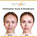 Max Strength Acne Face & Body Cream - Treat Cystic Blackhead & Whitehead Pimples Prevent Future Breakouts - Buy Online on GoSupps.com