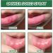 Mouth Bleeding Spray & Ulcer Treatment - Calming Mouth & Throat Spray (20ml) | Fast Relief for Mouth Wounds & Salivation - Buy Online on GoSupps.com