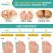 Puikos Bunion Corrector for Men & Women | Big Toe Splint & Hallux Valgus Relief | Adjustable Toe Straightener & Separator for Day/Night Use - Buy Online on GoSupps.com