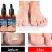 Ingrown Toenail Treatment Oil - 2PCS | Anti-Paronychia Relief & Ingrown Toenail Correction Drops - Buy Online on GoSupps.com