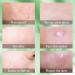 216PCs Hydrocolloid Pimple Patches - Invisible Waterproof Acne Treatment for Fast Healing | Two Sizes Available - Buy Online on GoSupps.com
