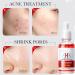 Friut Acid Face Serum for Acne Mark Salicylic Acid Anti Wrinkle Serum Fade Ance Mark & Shrink Pore Face Serum Hyaluronic Acid Acne Repair Serum for Sensitive Skin Smoothing Hyaluronic Serum-30ml - Buy Online on GoSupps.com