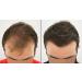 Natural Keratin Hair Fibre Refill for Hair Loss - 25g Grey (Pack of 1) | For Alopecia & Chemotherapy - Buy Online on GoSupps.com