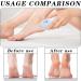 Creative Egg Foot Grinder Portable Egg Callus Remover Durable Manual Pedicure Tools for Dead Skin Removal White Highly Effective Callus Remover Wake up Velvety Feet for Foot Spa Home Salon - Buy Online on GoSupps.com