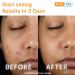 Acnefree 24 Hour Acne Clearing System Kit - Pack of 6 | International Shipping Available - Buy Online on GoSupps.com