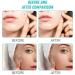 300 Pcs Invisible Hydrocolloid Pimple Patches with Tea Tree Oil & Salicylic Acid - Day & Night Waterproof Acne Treatment - Buy Online on GoSupps.com