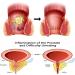 Heca Natural Herbal Hemorrhoid Capsules 2023 - Natural Relief for Hemorrhoids - 2pcs - Buy Online on GoSupps.com