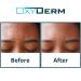 Acne Clearing Treatment Pads - Salicylic, Glycolic & Lactic Acid Formula for Cystic Breakouts and Oily Skin - Buy Online on GoSupps.com