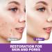 Buy Azelaic Acid Cream & 12% Serum - Skin Hyaluronic Acid & Niacinamide for Redness Relief - Fast International Shipping - Buy Online on GoSupps.com