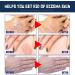 GFOUK Natural Eczema Therapy Spray All Natural Eczema Treatment Psoriasis Treatment Vitiligo Skin Repair Spray Skin Care Pain & Itch Spray Fast Acting Itch Relief (1 Pcs) - Buy Online on GoSupps.com