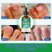 Ingrown Toenail Treatment Drops - Fast Acting Pain Relief & Softener 30ml - Buy Online on GoSupps.com