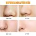 10pcs Hydrocolloid Blackhead Removal Patches | Deep Cleansing Pore Strips for Face, Nose, and Pores | Dermatologist Approved | Overnight Use - Buy Online on GoSupps.com