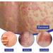 EXQST 30ml Psoriasis Repair Spray - Herbal Treatment for Skin Plaque Psoriasis - Stops Burning and Itching - 3pcs - Buy Online on GoSupps.com
