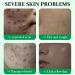 Salicylic Acid Acne Cream 50g - 3% BHA Spot Cream for Acne - Blackhead Remover - Dark Spot Remover for Face - Scar Removal Cream - Moisturizing Face Cream for Women - Pimple Cream for Redness - Buy Online on GoSupps.com