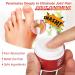 Bunion Pain Relief Cream 10g - Natural & Portable Solution for Back, Neck, Knee, Hand, Wrist, Shoulder, and Feet - Buy Online on GoSupps.com
