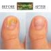 Nail Fungus Soak - Natural Solution for Toenail and Fingernail Issues - Combat Cracked Heels and Athlete's Foot - Hypoallergenic Fungus Remover for Feet and Hands - Buy Online on GoSupps.com