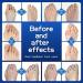 Pack of 8 Gel Toe Separators - Toe Spacers for Overlapping Toes, Crooked Toe Correction, Bunions, Hallux Valgus - Beige - Buy Online on GoSupps.com