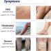 Xiyinli 30 ml Non-Toxic Varicose Vein Spray Relieves Swelling & Pain Improves Circulation - Buy Online on GoSupps.com