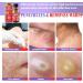 Wart Remover Liquid | Maximum Strength Gel Mask for Plantar & Common Warts | Safe & Natural Formula - Buy Online on GoSupps.com