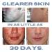 Sensitive Skin Acne Treatment Kit | Sulfur Lotion Foaming Cleanser & Toner | 1-Month Hormonal Acne Solution - Buy Online on GoSupps.com