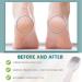 Stainless Steel Heel Scraper for Cracked Heels Foot Grater Callus Remover for Foot Care (2) - Buy Online on GoSupps.com