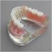 Dental Upper Implantate Model - Superior Overdenture Restoration for Education | Transparent Vision & Soft Gum - Ideal Study Tool - Buy Online on GoSupps.com
