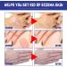 EXQST 30ml Psoriasis Repair Spray - Herbal Treatment for Skin Plaque Psoriasis - Stops Burning and Itching - 3pcs - Buy Online on GoSupps.com