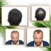  VIDALFORCE Volumizing thickening powder for hair - Baldness hair loss & roots - Natural keratin microfibers. Hair loss concealer | Medium Brown (Fixer + Fibers) | - Buy Online on GoSupps.com