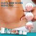 Advanced Scar Removal Cream - Silicone Gel for Old & New Scars, Acne, C-Section, Burns & Stretch Marks - Moisturizing Skin Repair - 2PCS - Buy Online on GoSupps.com