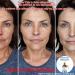 VEZE Botox Face Serum | Anti-Aging Instant Lift Cream for Women | 30ml Botox Serum - Buy Online on GoSupps.com