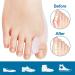 Gel Toe Spreader & Protector (4 Pieces) - Pain Relief for Crooked Hallux Valgus & Overlapping Toes | Toe Cushion & Separator for Comfort - Buy Online on GoSupps.com