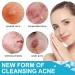 Jonov Acne Pimple Patch - Fast Acting Hydrocolloid Pimple Patches for Night - 18 Blemish Cover Stickers for Face - Buy Online on GoSupps.com